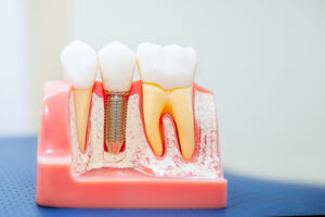 Sorident Plus Implantul Dentar